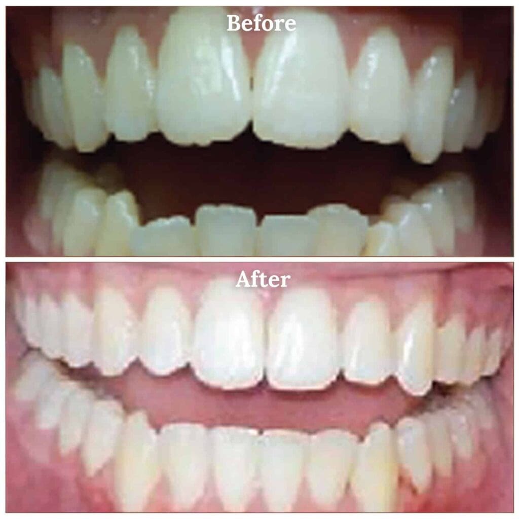 Grayson teeth