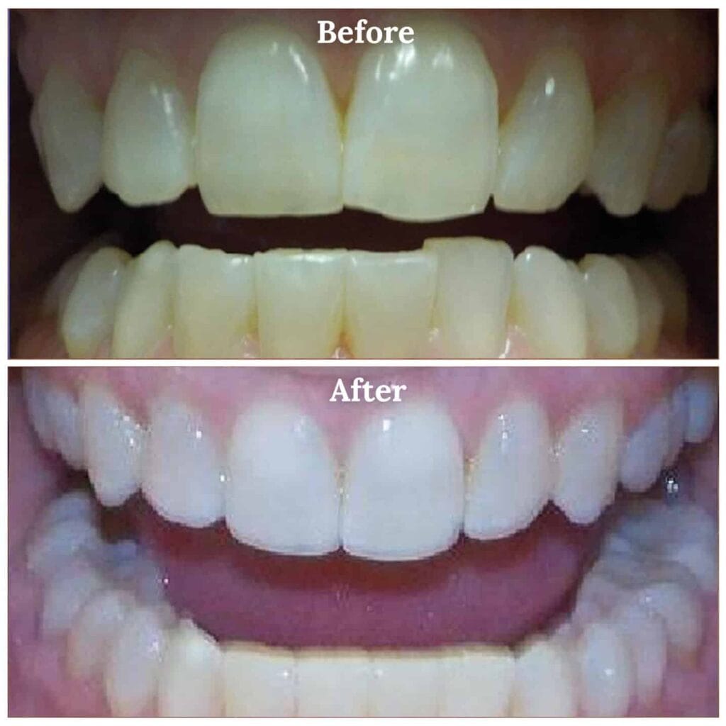 Jesselyn teeth